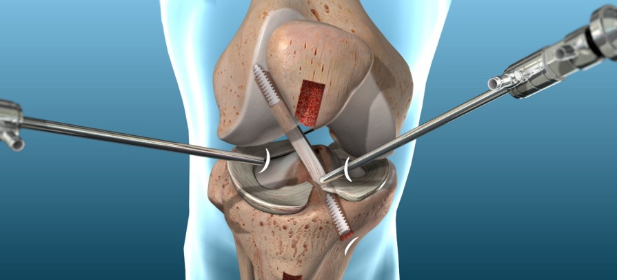 ACL-rekonstruktión.jpg
