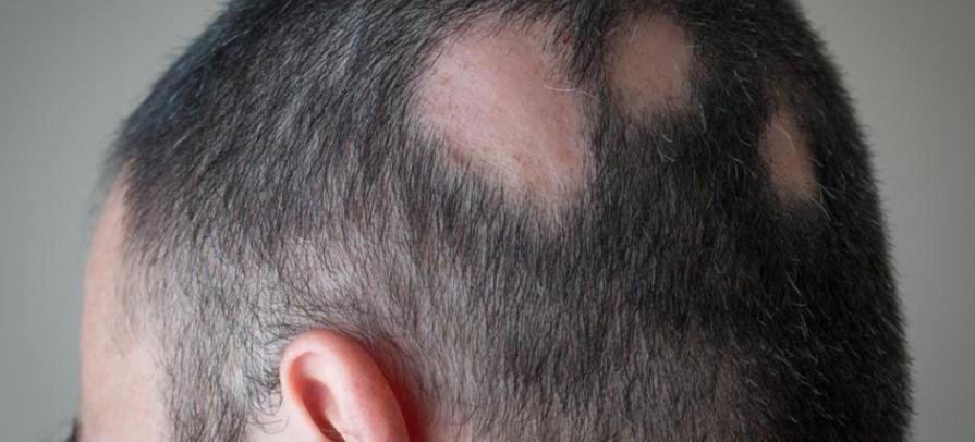 Alopecia Areata