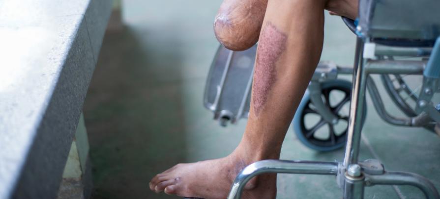 Beinamputation
